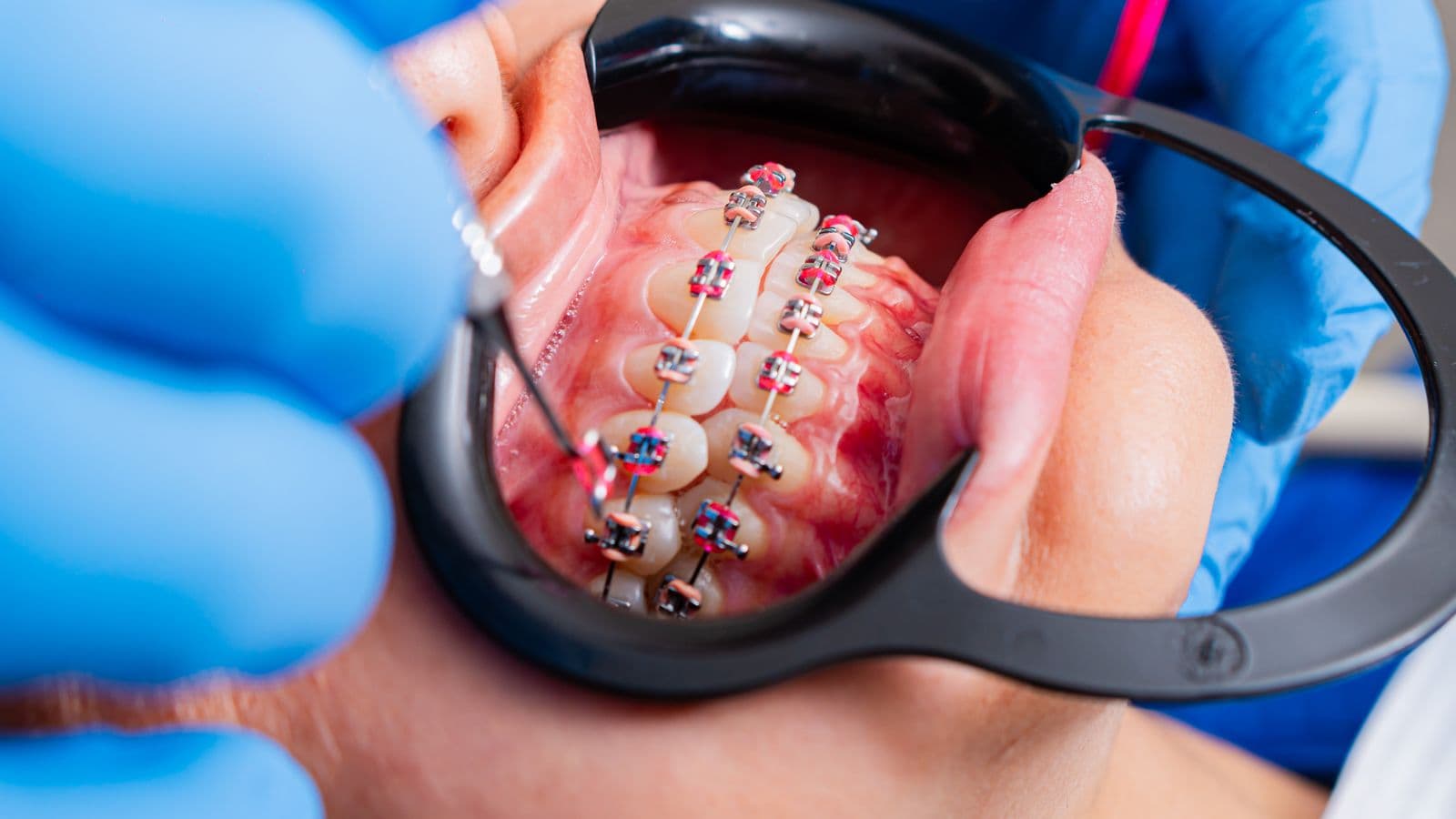 Close-up of metal braces with coloured elastic ties, held open with a cheek retractor