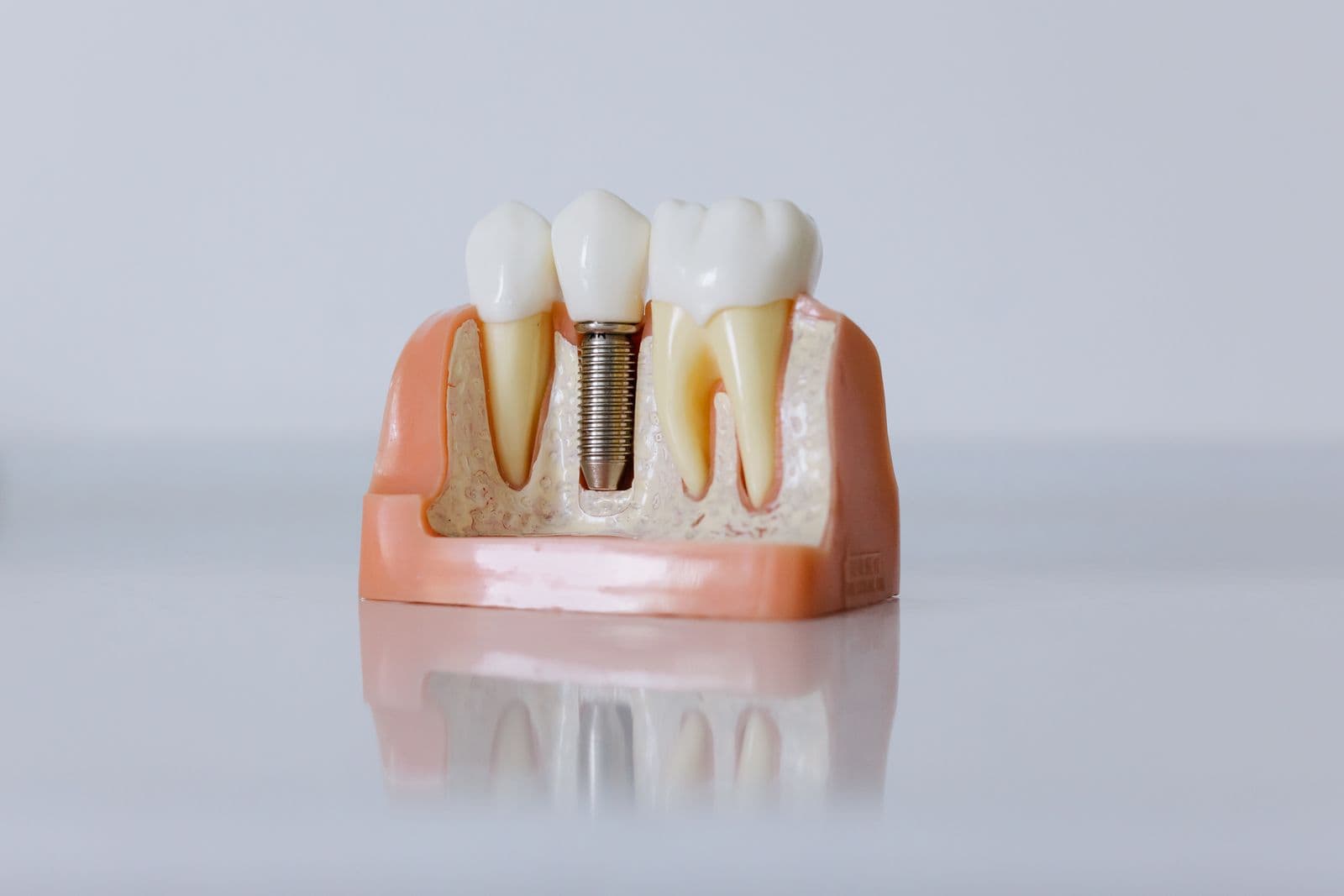 Cross-section model of a titanium dental implant fused between two natural teeth