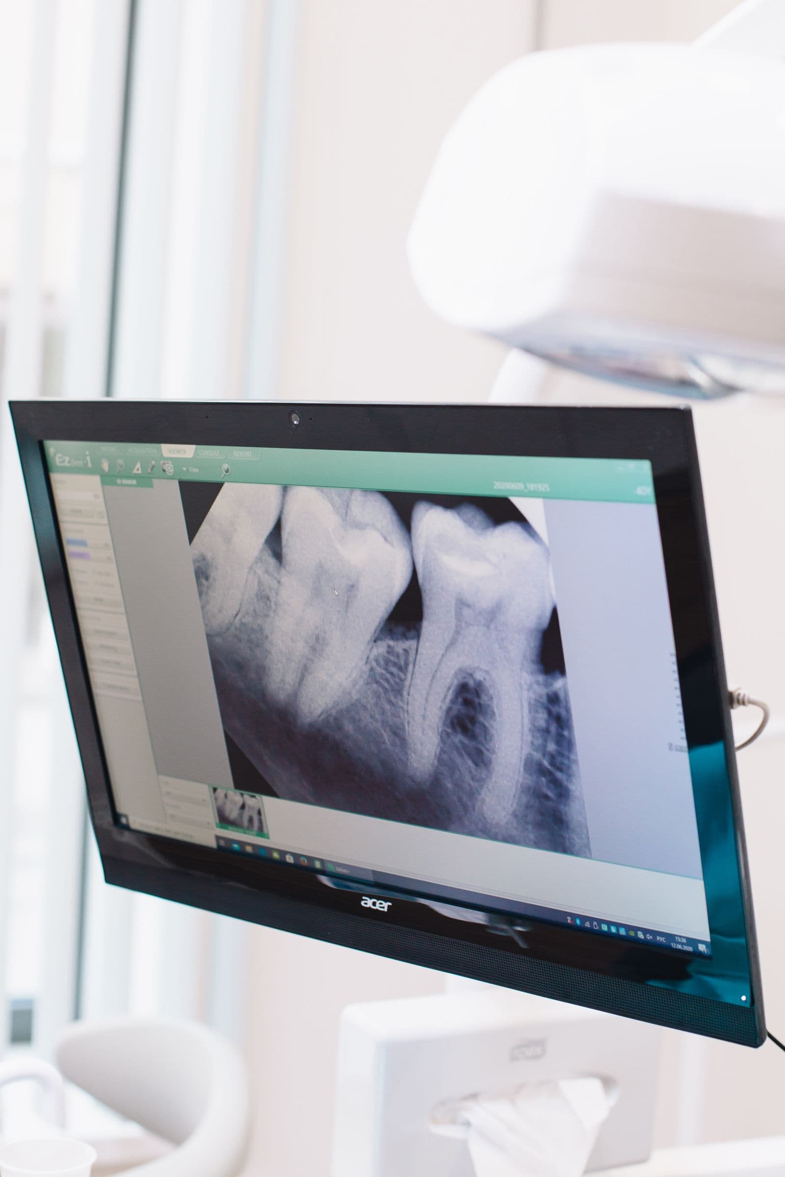 A dental X-ray of lower molars shown on a monitor in a dental clinic