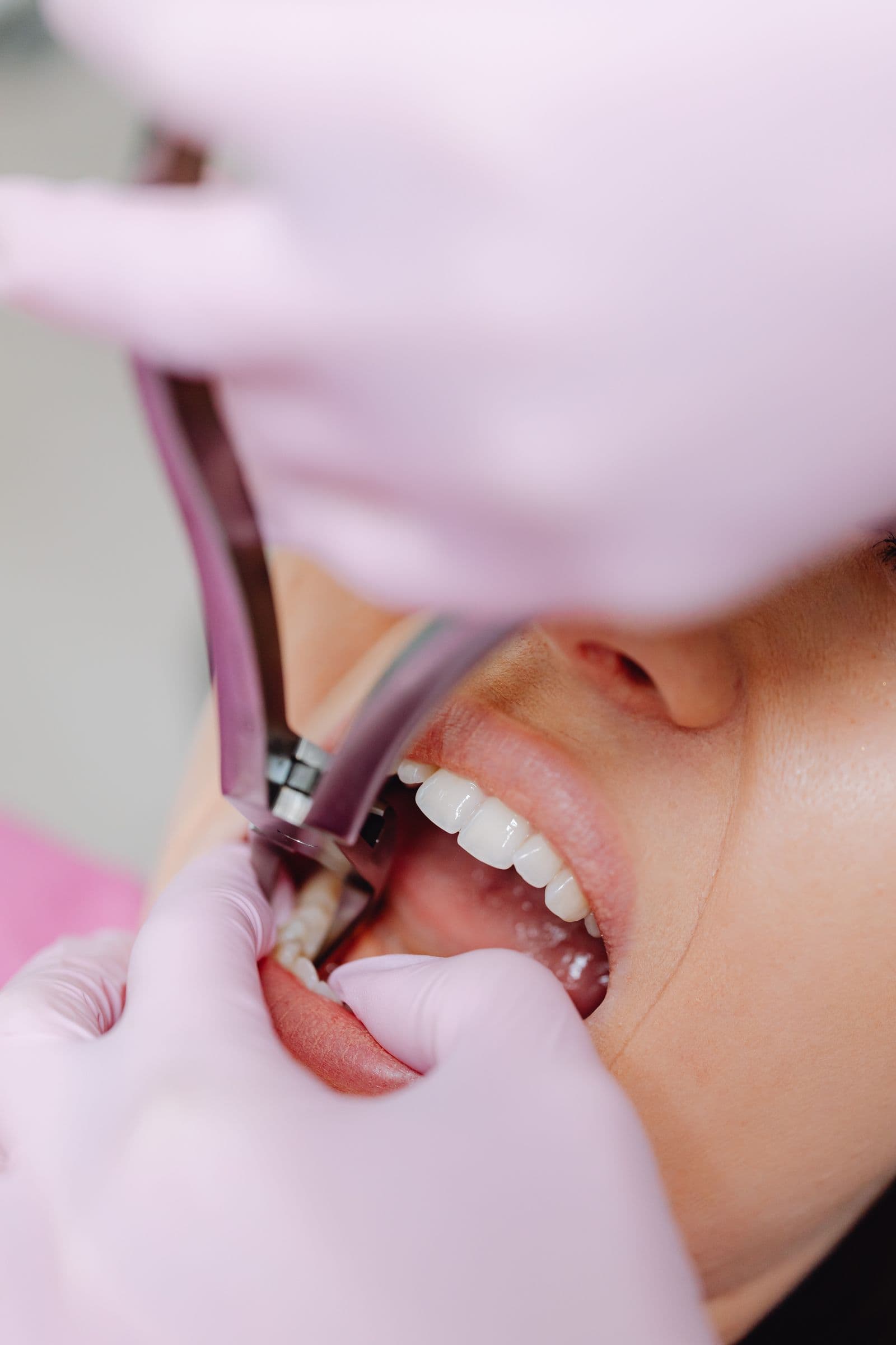A dentist using extraction forceps on a lower tooth, with pink-gloved hands supporting the patient's mouth