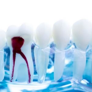 root-canal-treatment-penrith