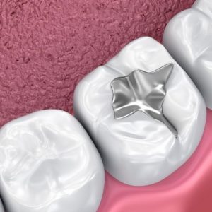 tooth-fillings-penrith