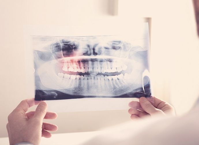 wisdom-teeth-exam