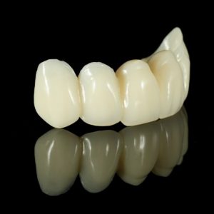 dental-bridge-penrith